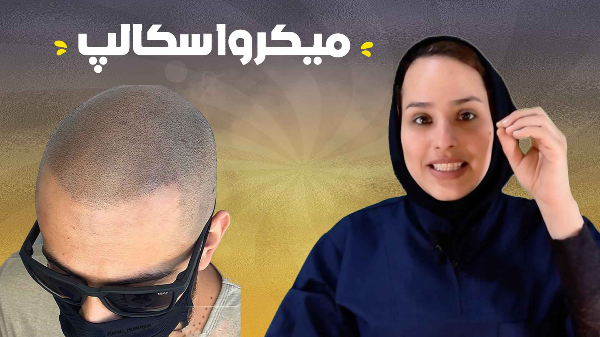 درمان طاسی با میکرو اسکالپ