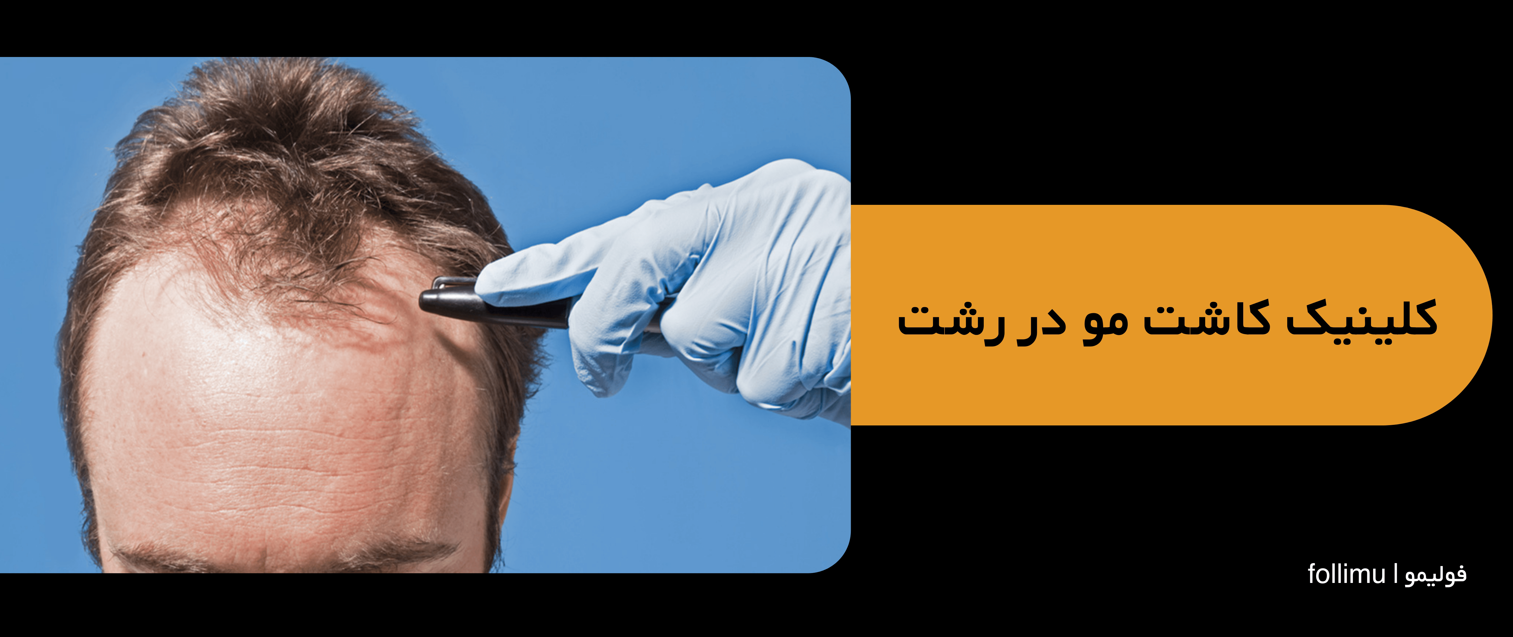 بهترین کلینیک کاشت مو در رشت