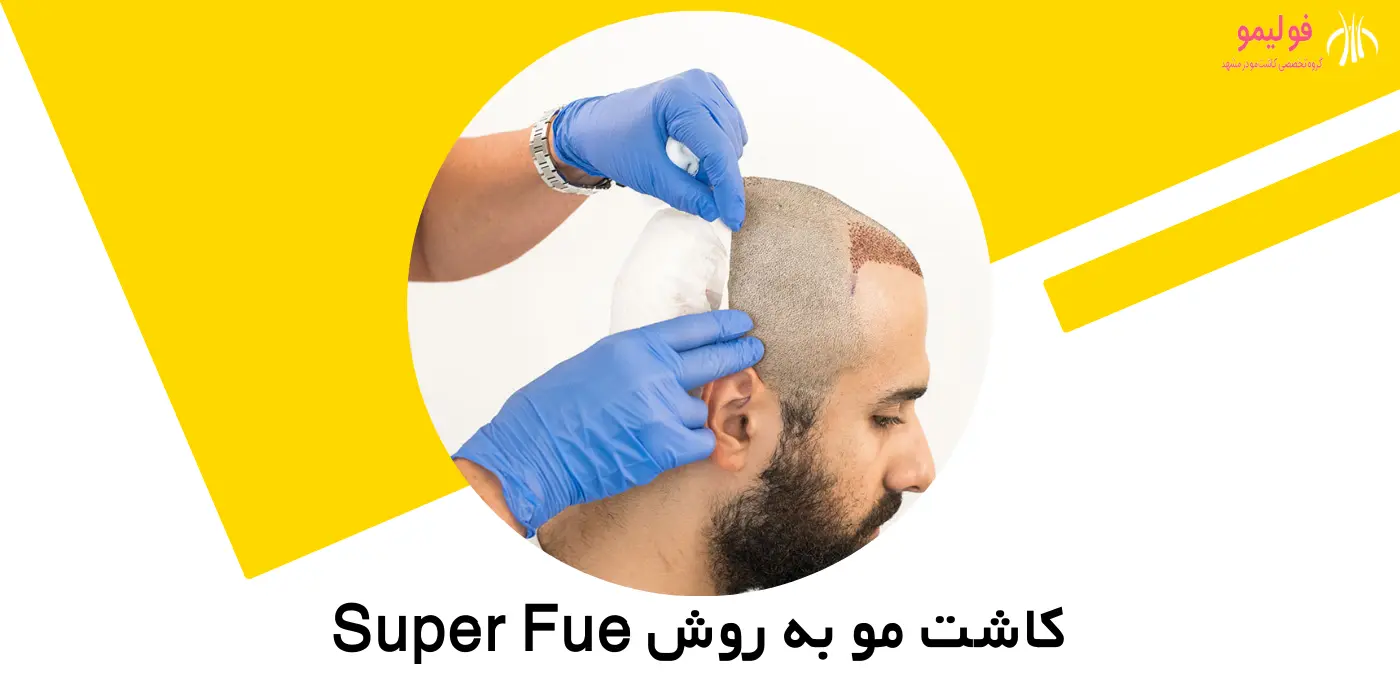 تصویر کاشت مو به روش Super Fue